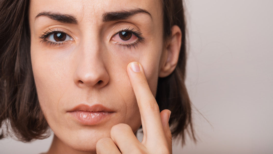Frau zeigt gerötetes Auge